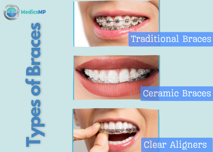 Teeth Braces Price in Pakistan 2025 | Metal, Ceramic & Invisible Options