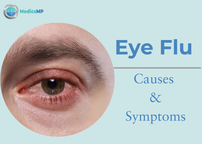 Eye Flu: Causes, Symptoms & Effective Treatment